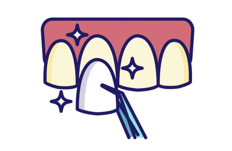 What Are Porcelain Veneers?