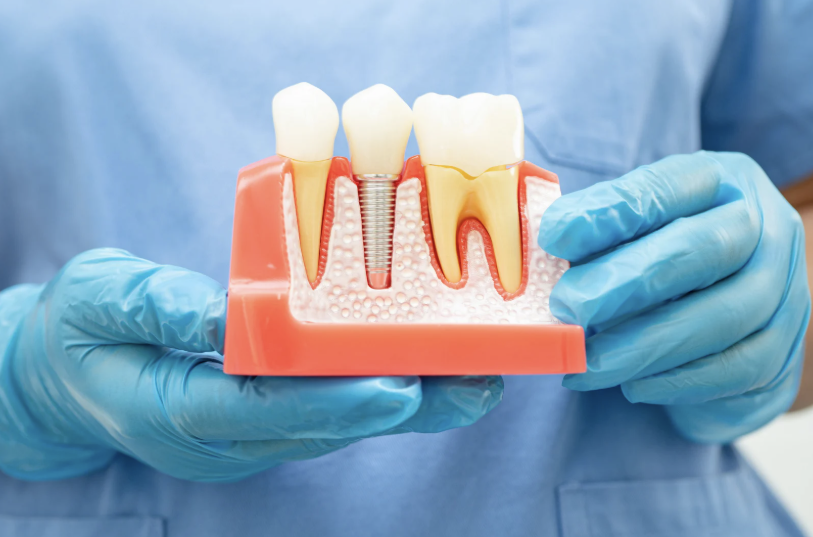 The Benefits of Dental Implants