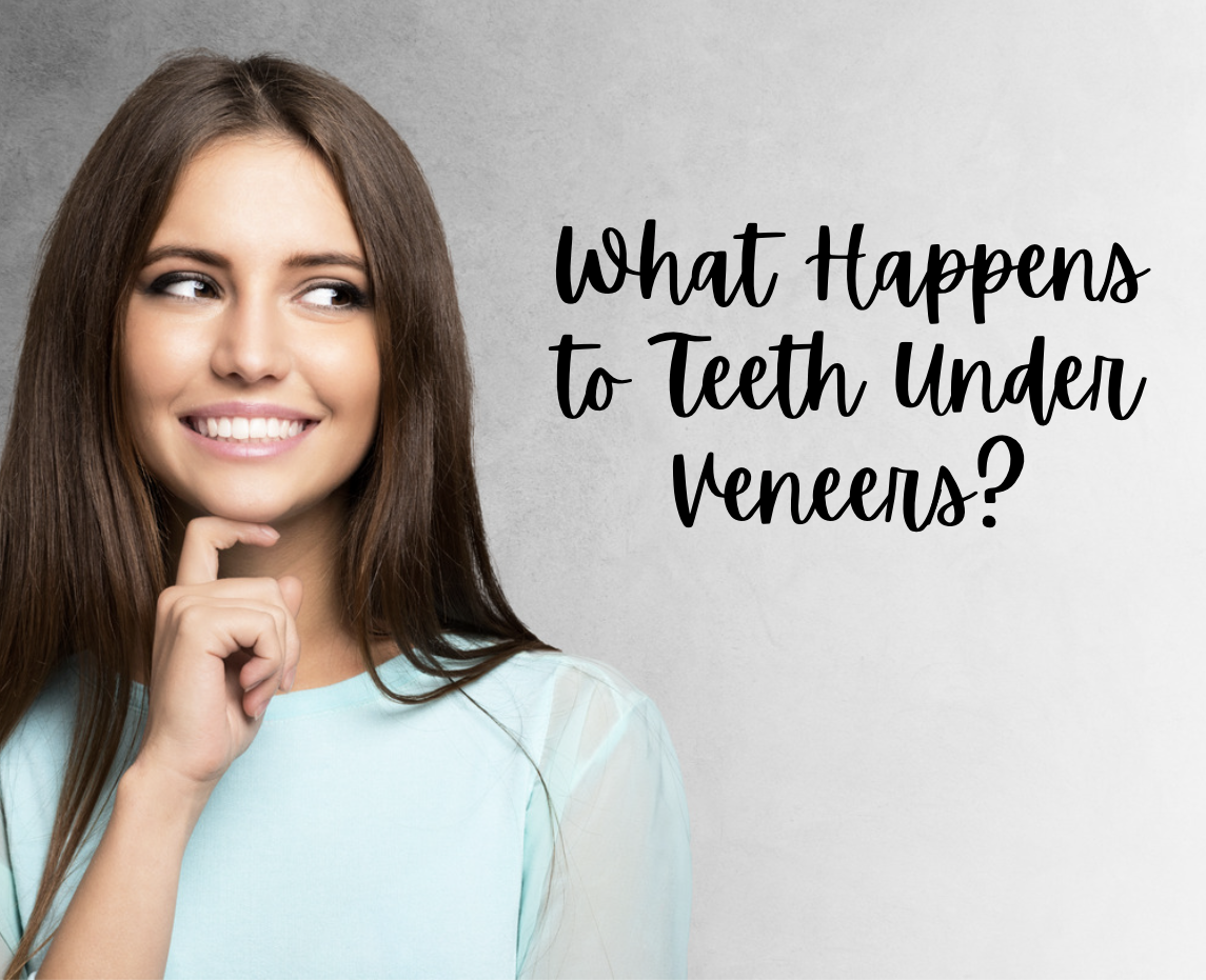 What Happens to Teeth Under Veneers?