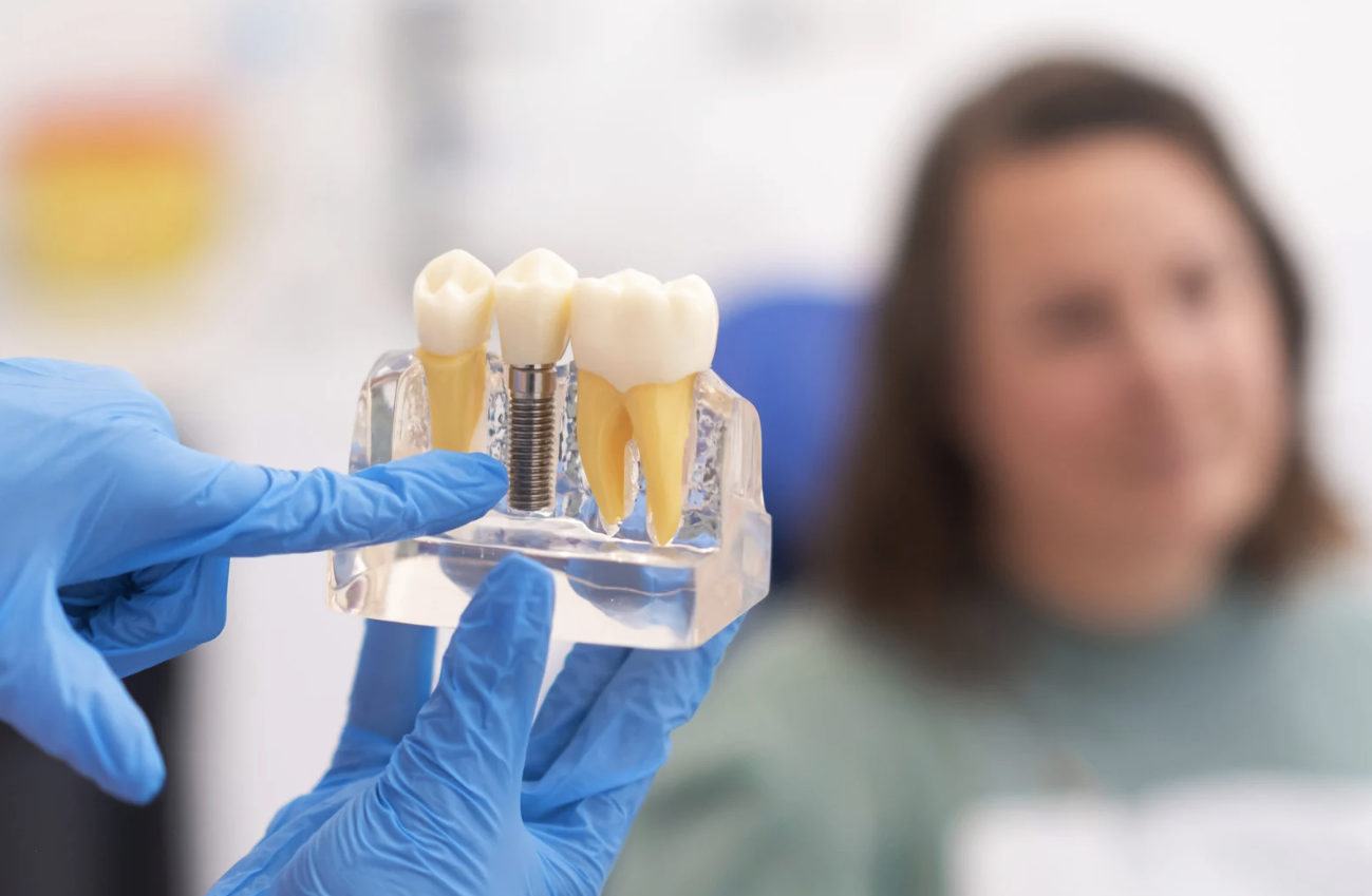 The Full Mouth Reconstruction Process: What You Need to Know