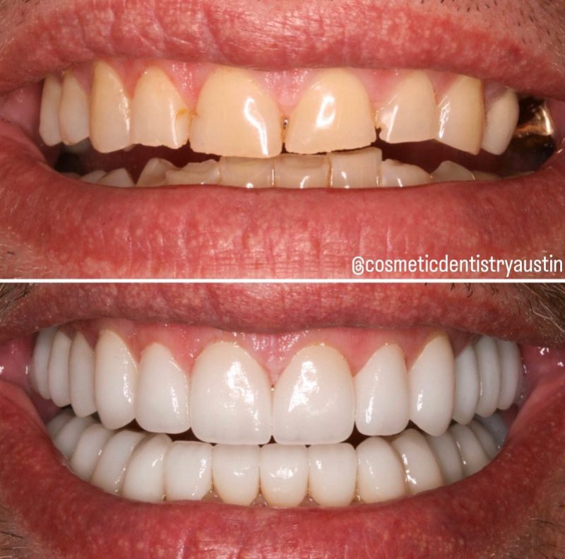 Is a Smile Makeover Right for Me?