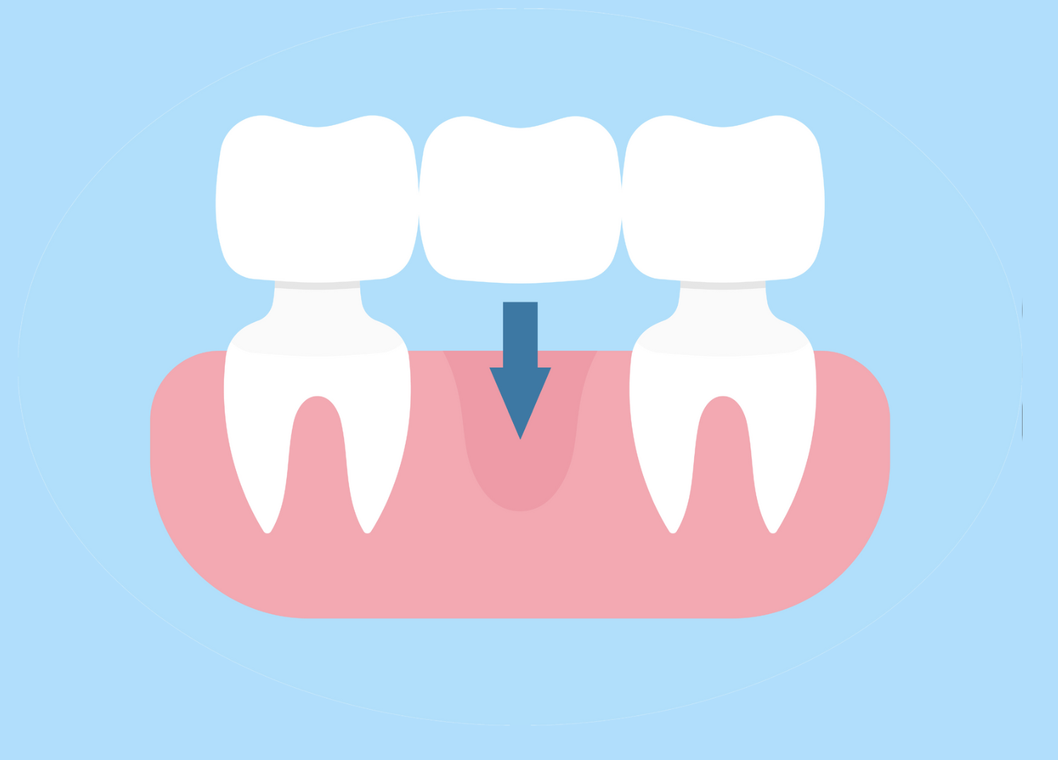 Dental Bridges vs. Dental Implants