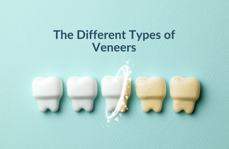 The Different Types of Veneers