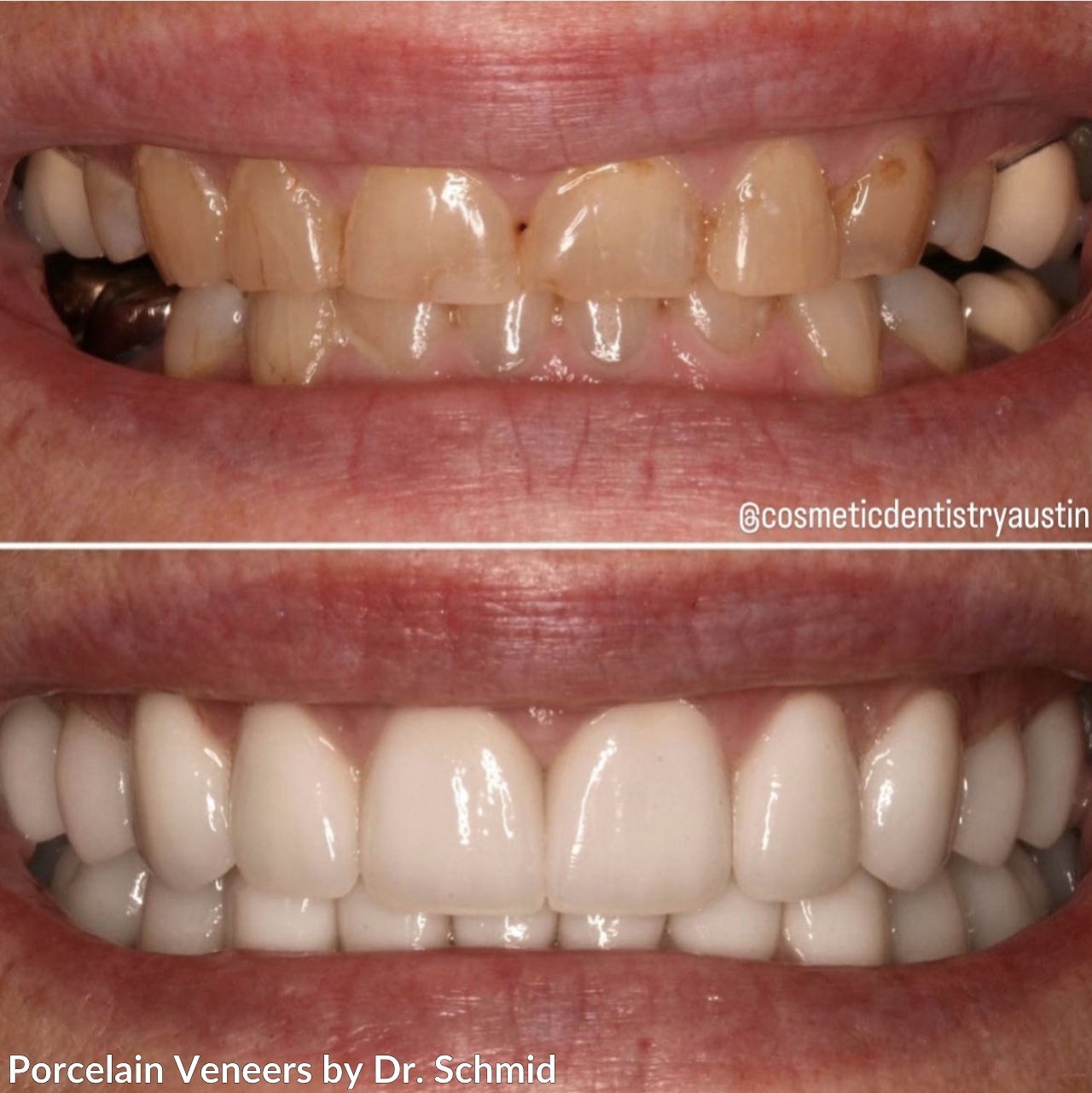 Can You Get Veneers with Bad Teeth?