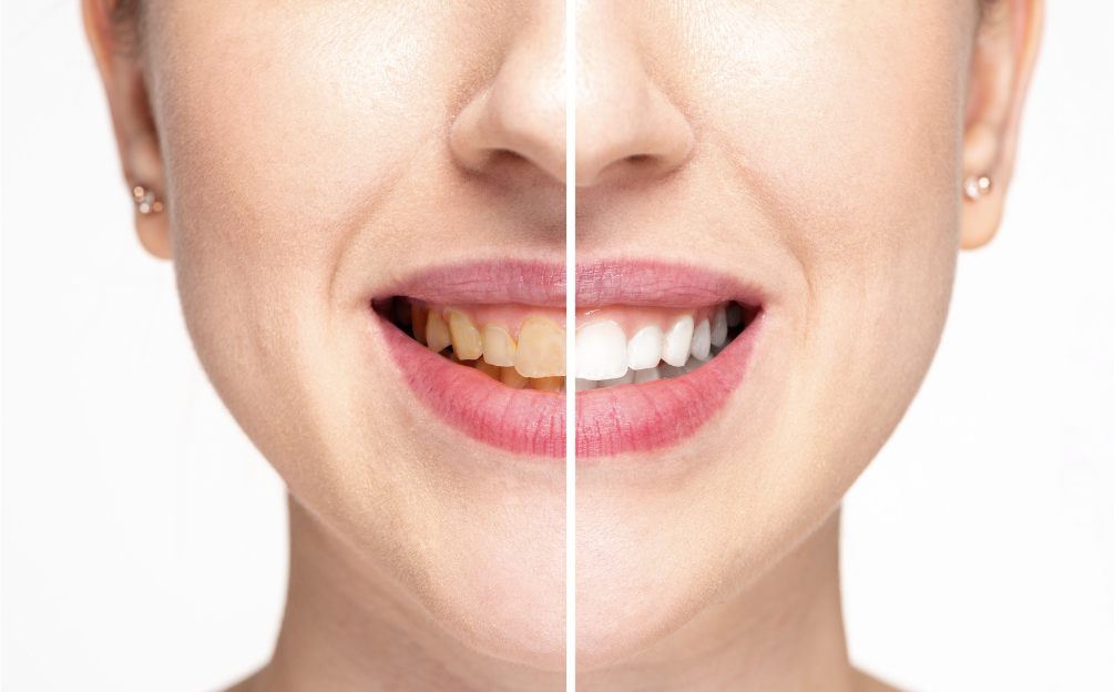 Are My Daily Habits Making My Teeth Yellow?