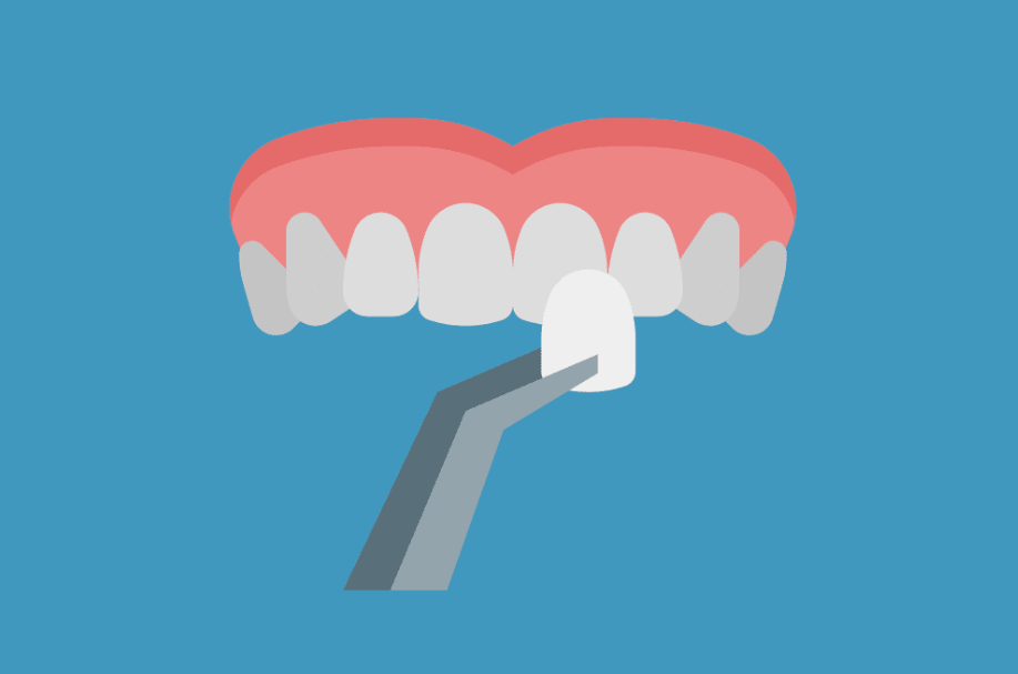 Composite Vs. Porcelain Veneers