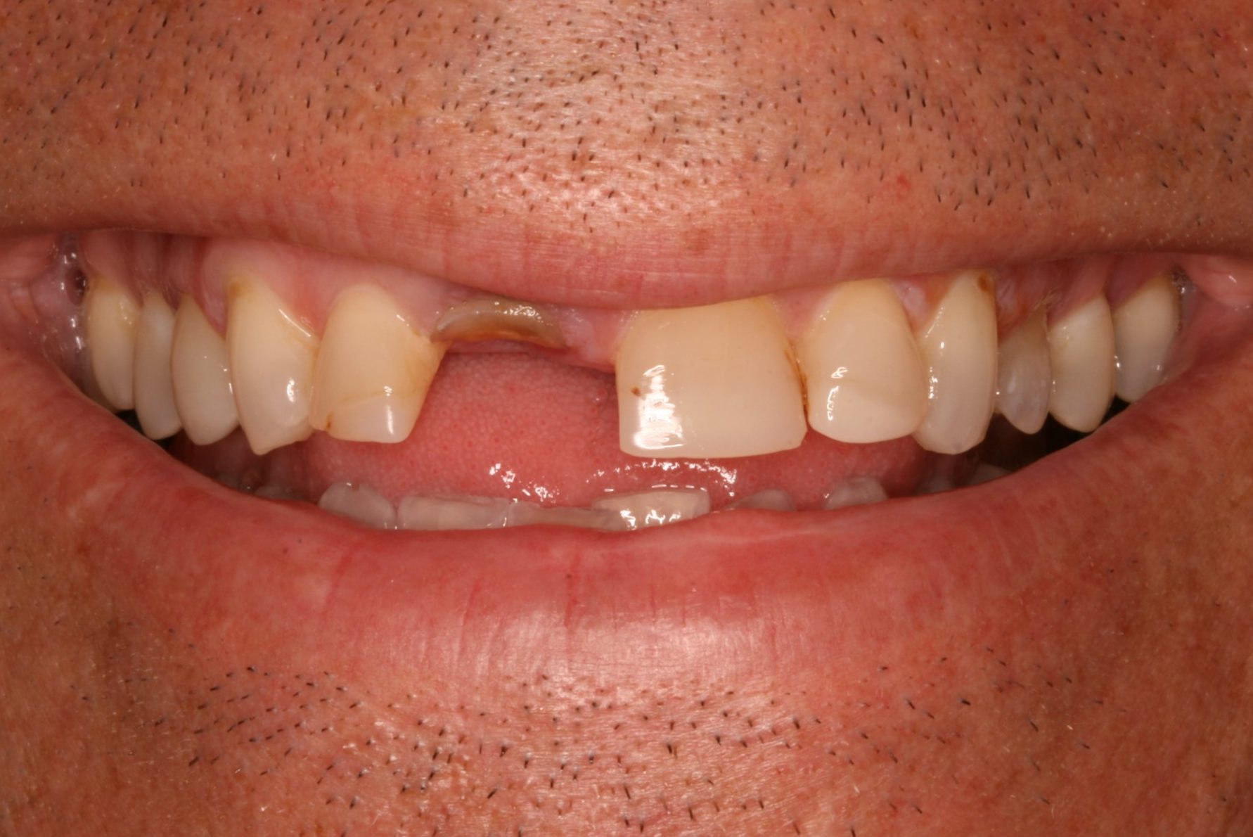 Can Dental Veneers Fix Missing Teeth?