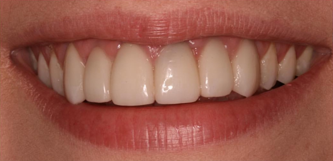 What is Veneer Leakage?