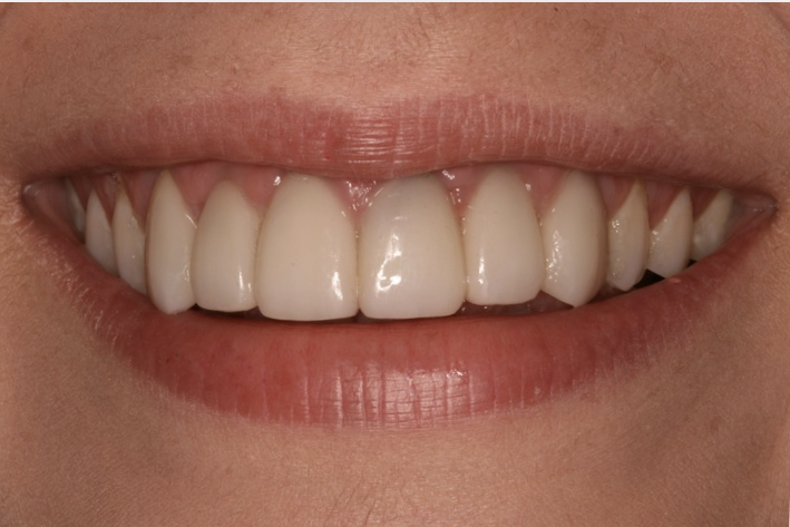 6 Signs It’s Time to Replace Your Porcelain Veneers