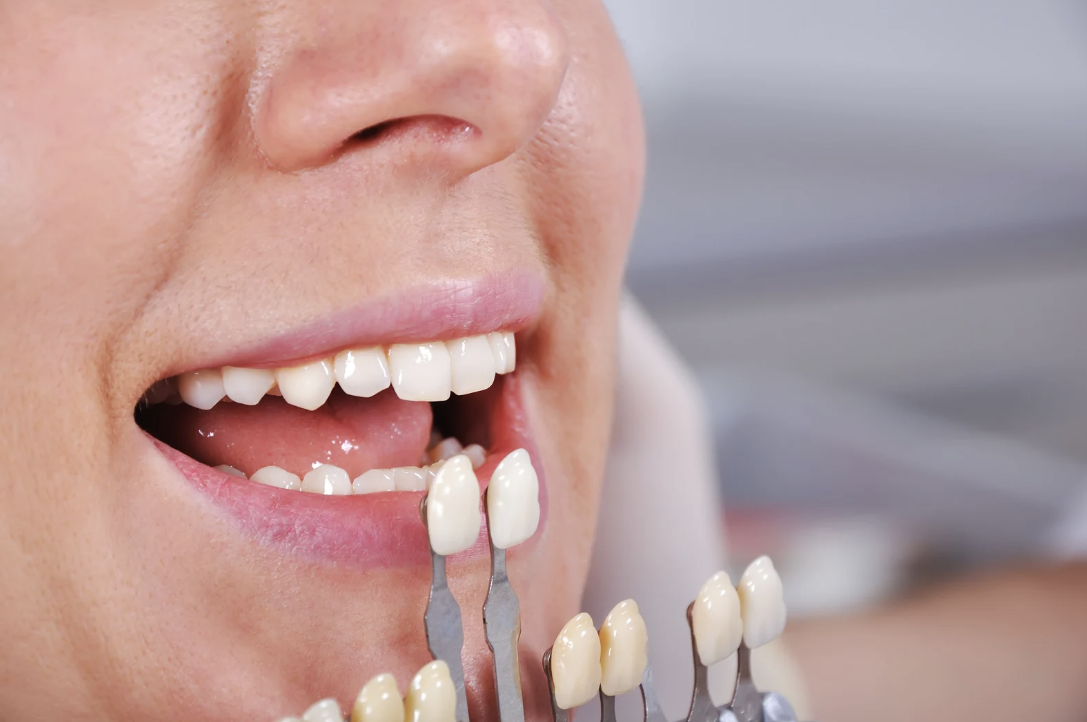 Are Veneers Fake Teeth?