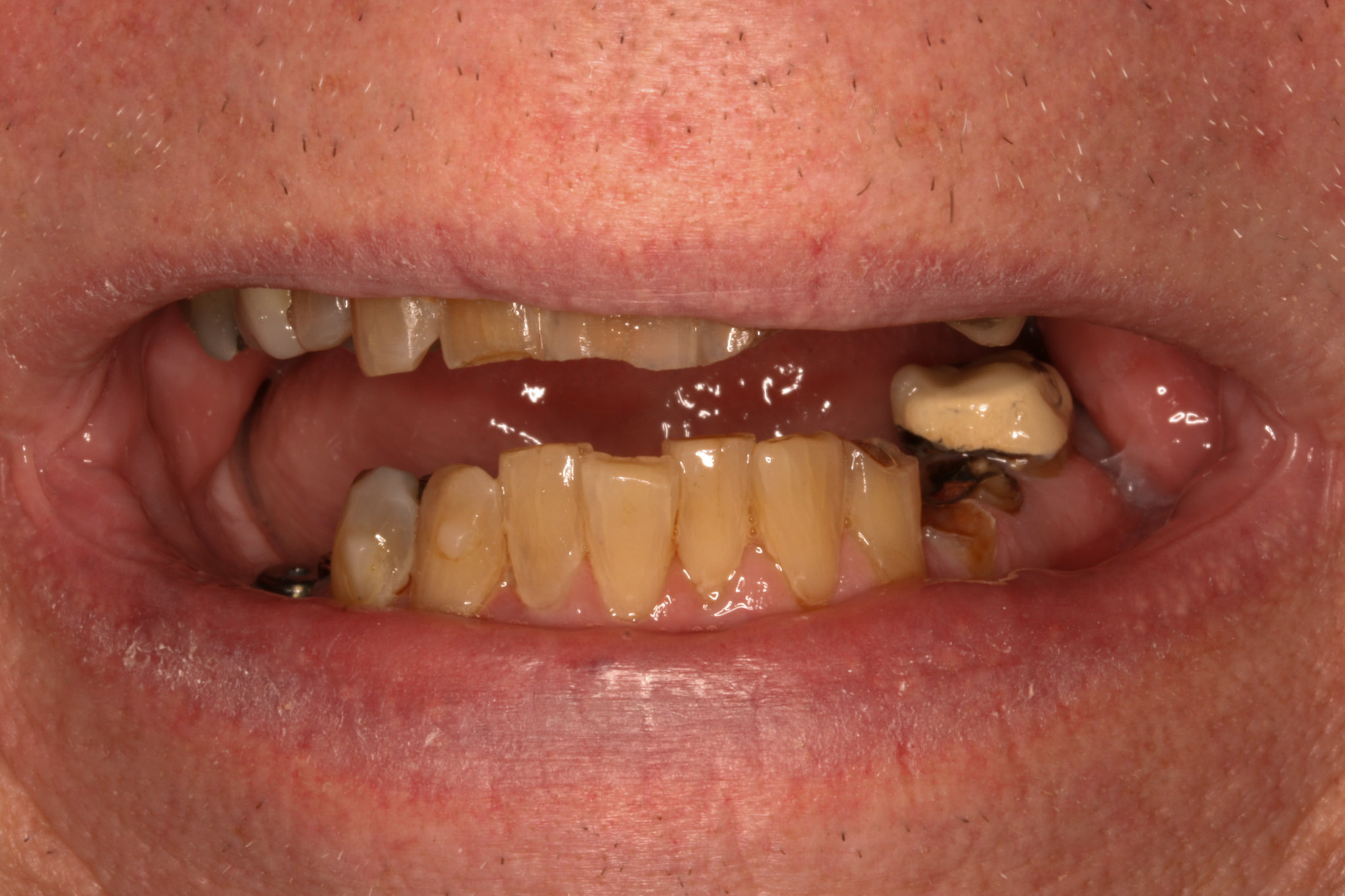 Can You Get a Smile Makeover If You Have Tooth Decay?