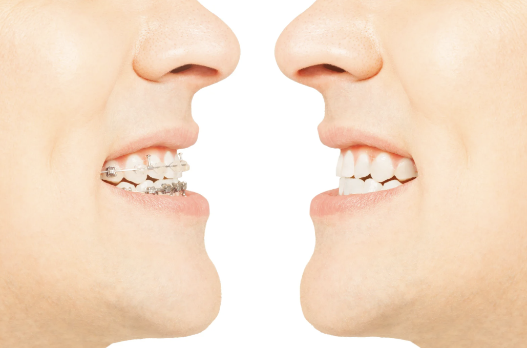 ClearCorrect vs. Traditional Braces: Which Is Better?