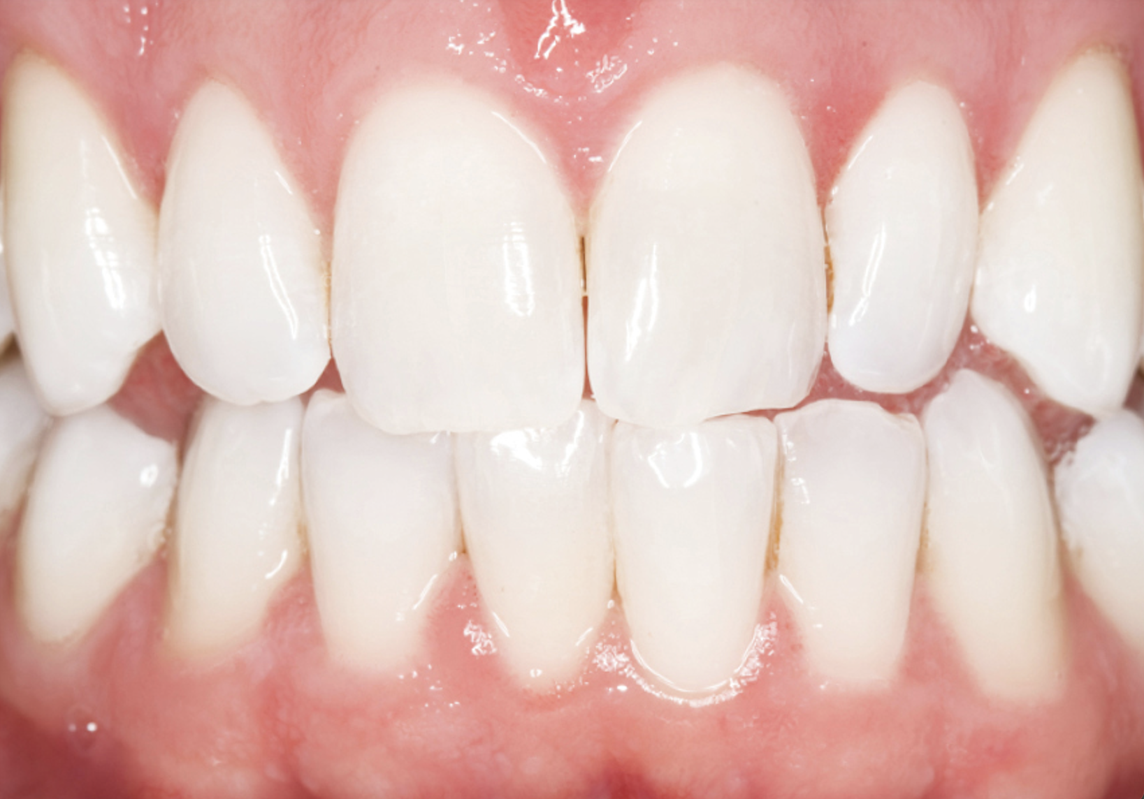 Opalescence Whitening: How It Works and Why It’s Popular