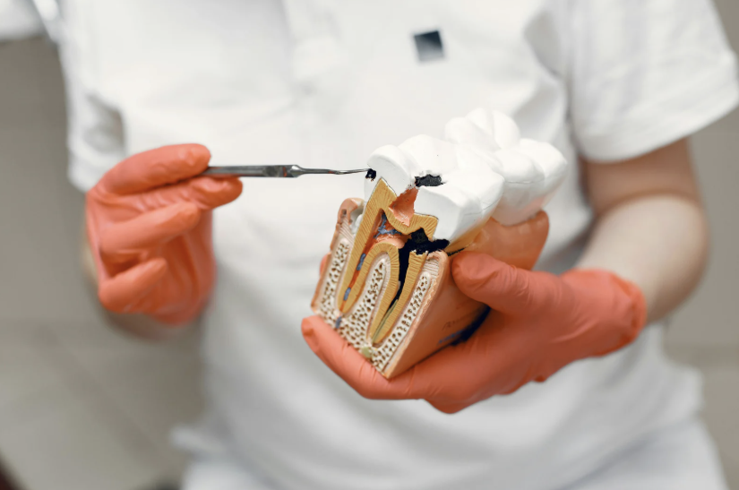 Can You Get Cavities With Veneers?