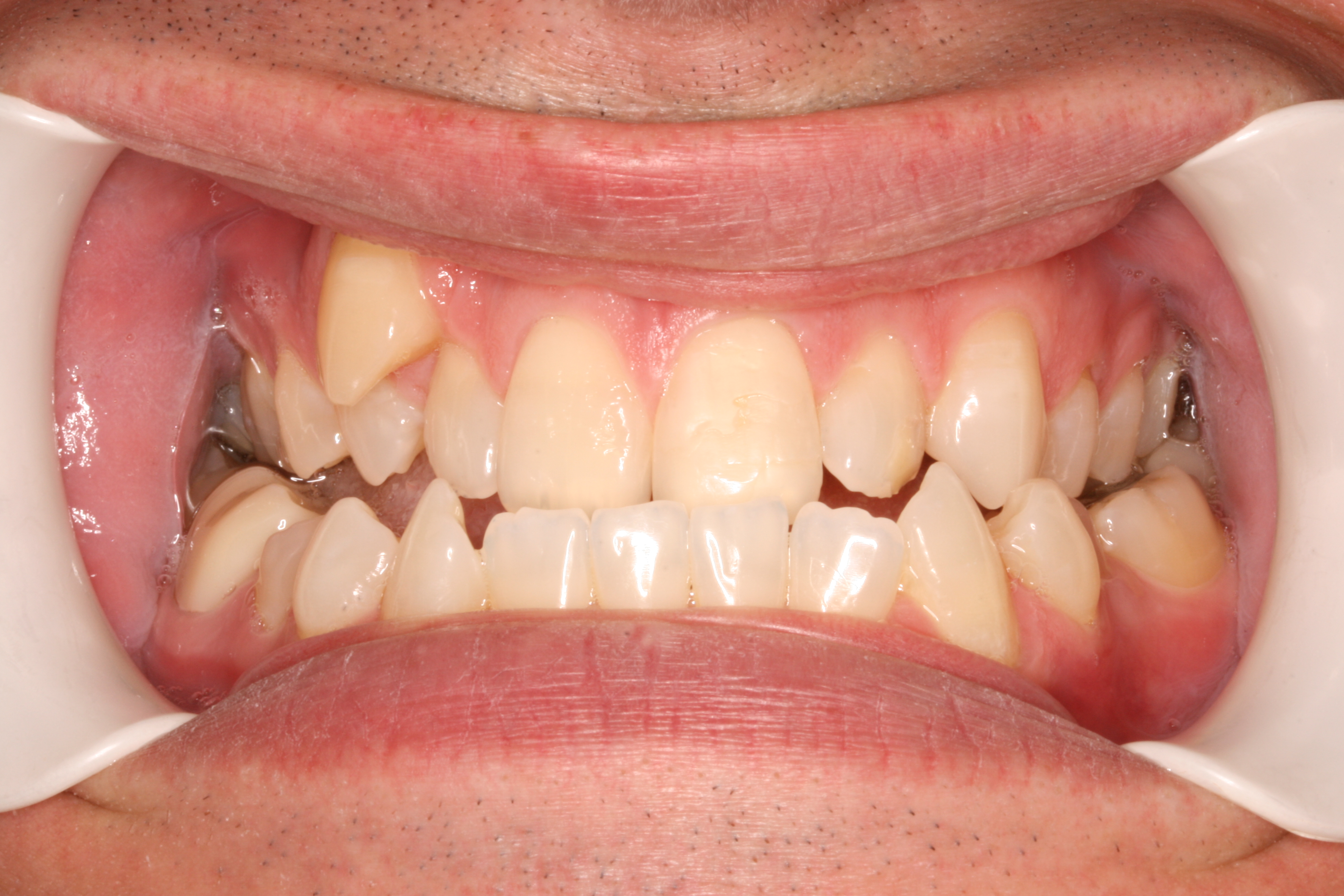 Smile Makeover for an Ectopic Tooth in Austin, TX