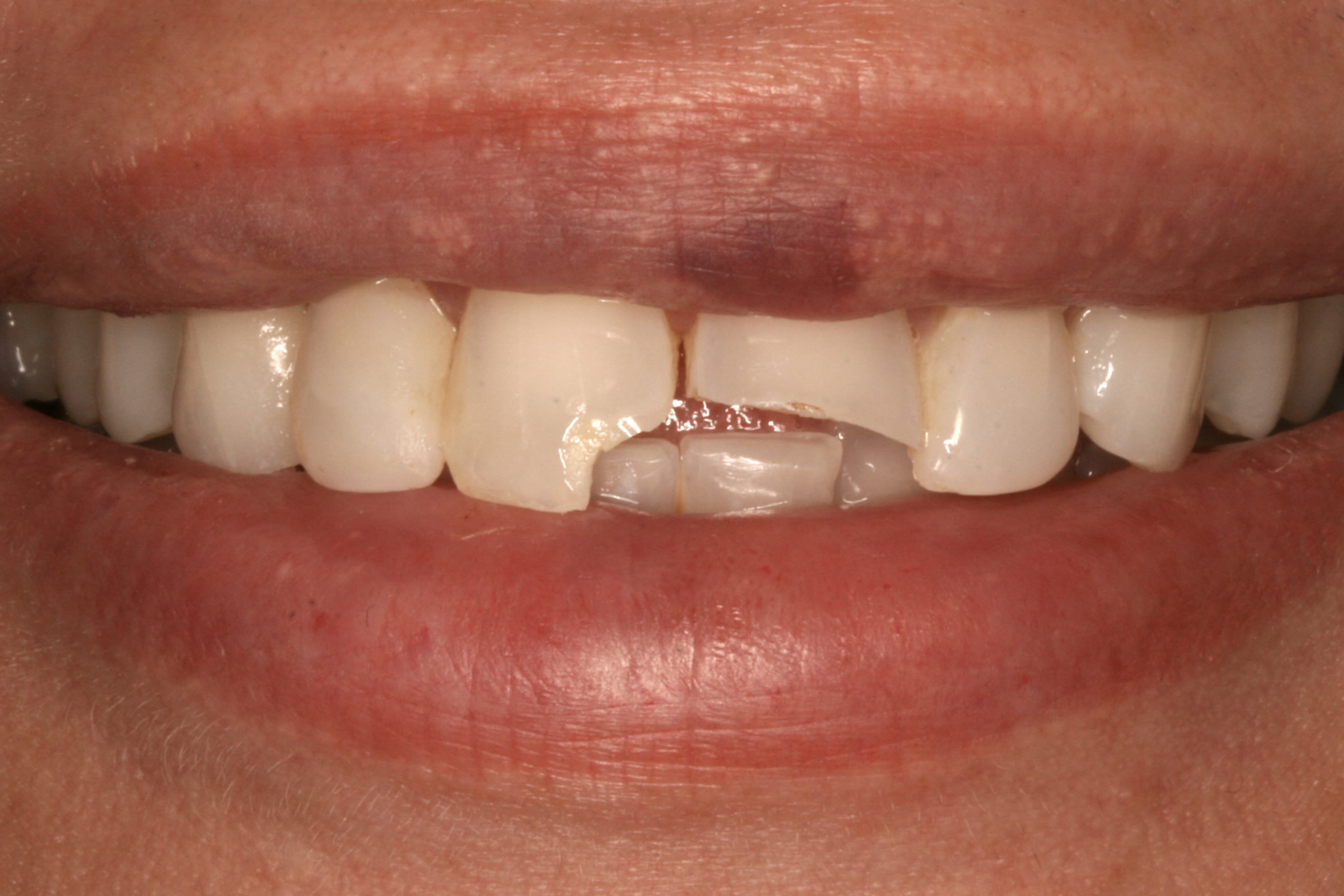 Fixing Broken Front Teeth With Porcelain Veneers in Austin, TX
