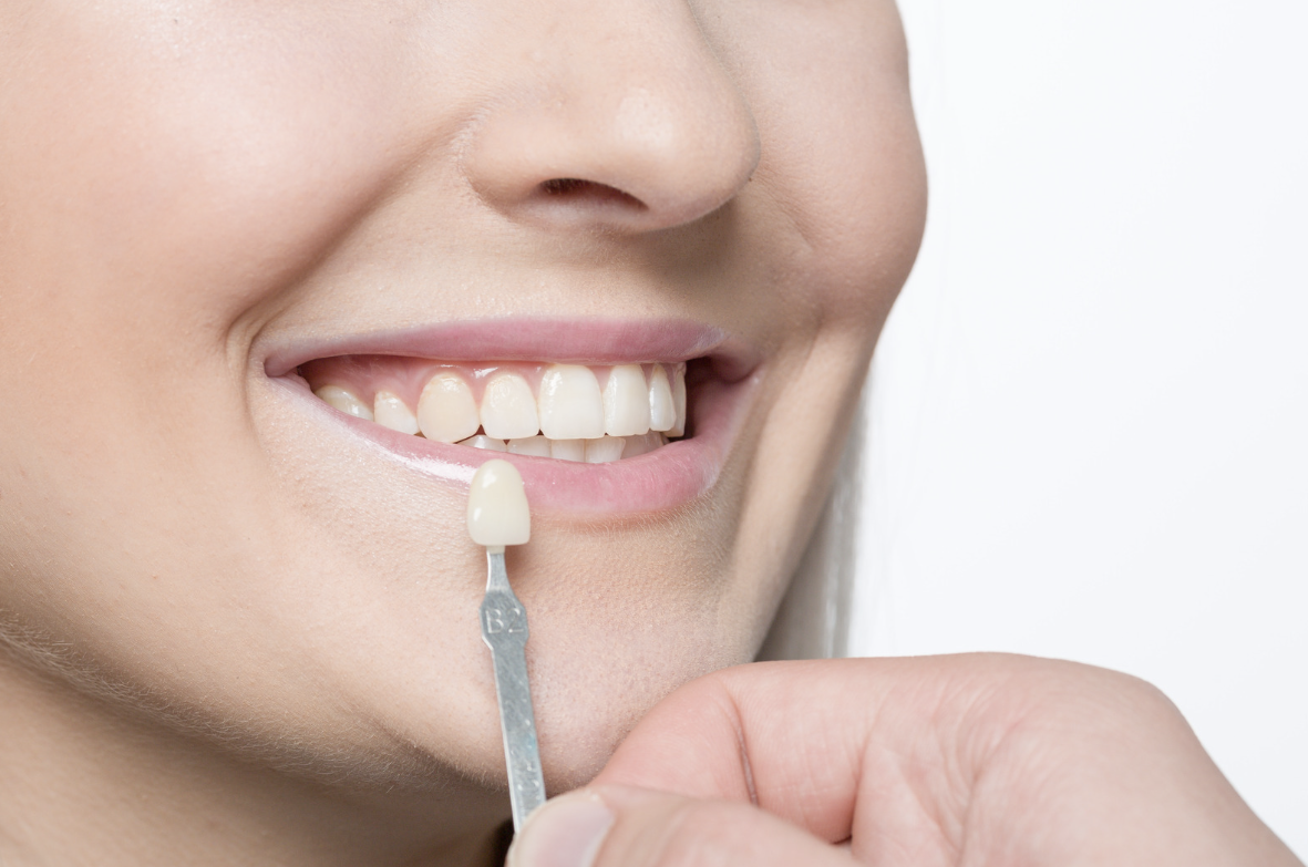 Do Veneers Protect Teeth?