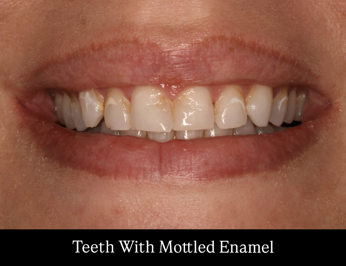 Understanding Dental Mottling: Causes and Solutions