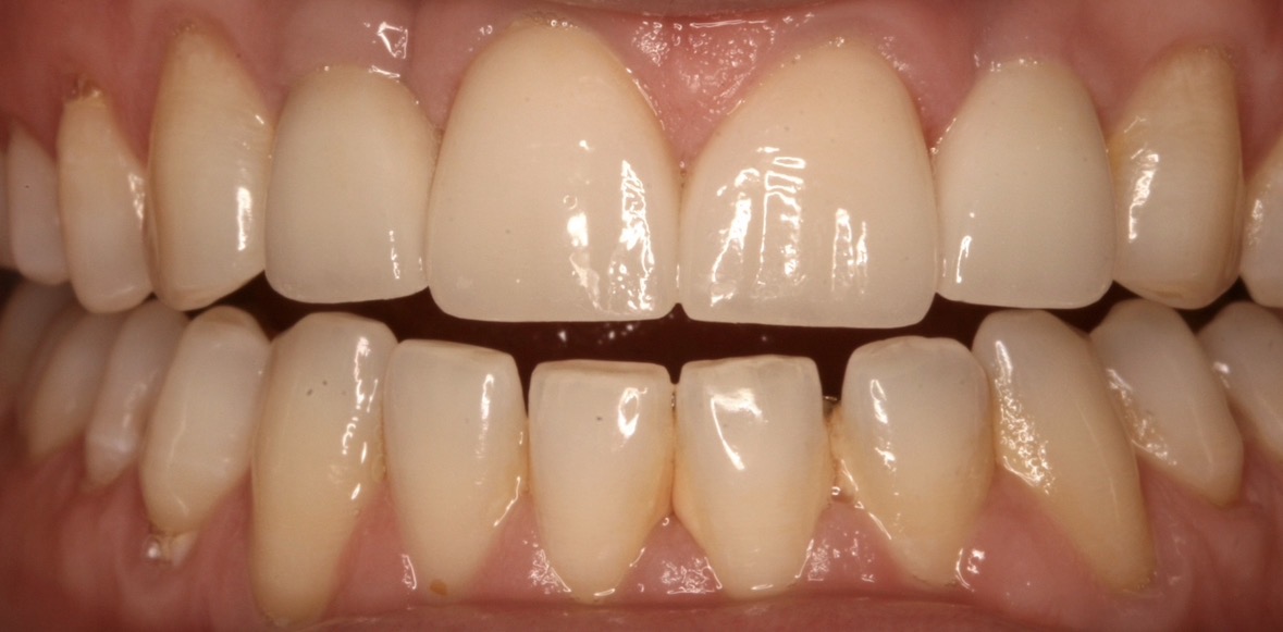 Smile Makeovers For Patients With Dental Implants in Austin, TX