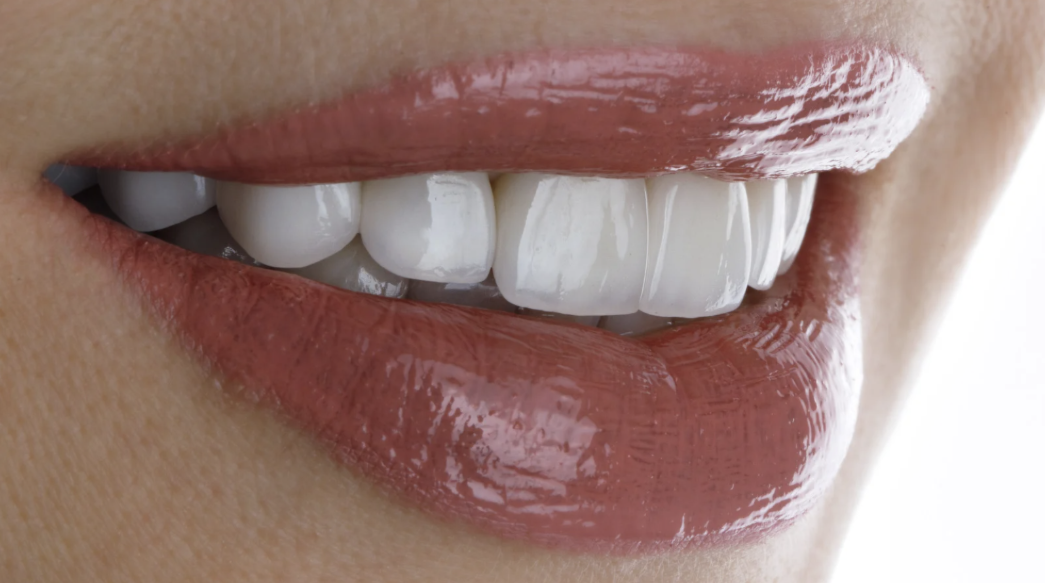 Do Veneers Look Fake?