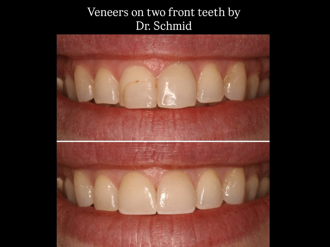 Veneers on 2 Front Teeth: What to Expect
