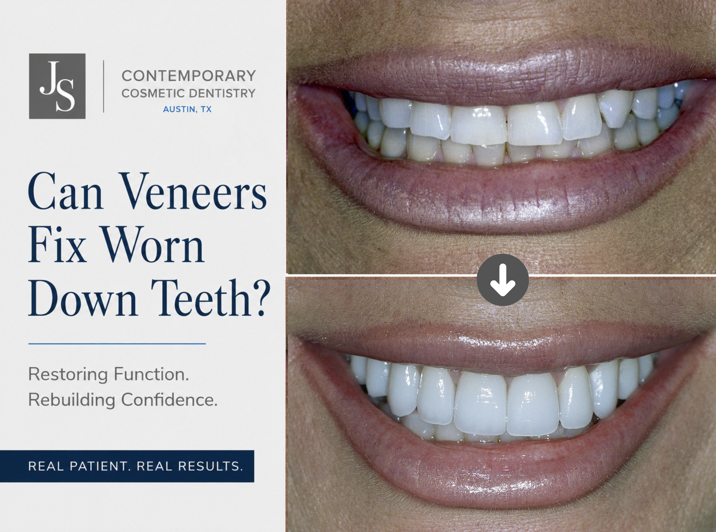 Can Veneers Fix Worn Down Teeth?